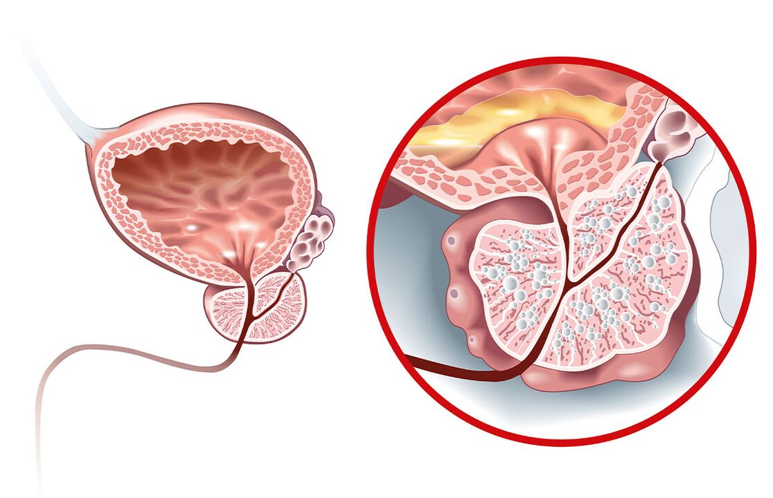 Kas nutinka prostatai, sergant adenoma ir prostatitu