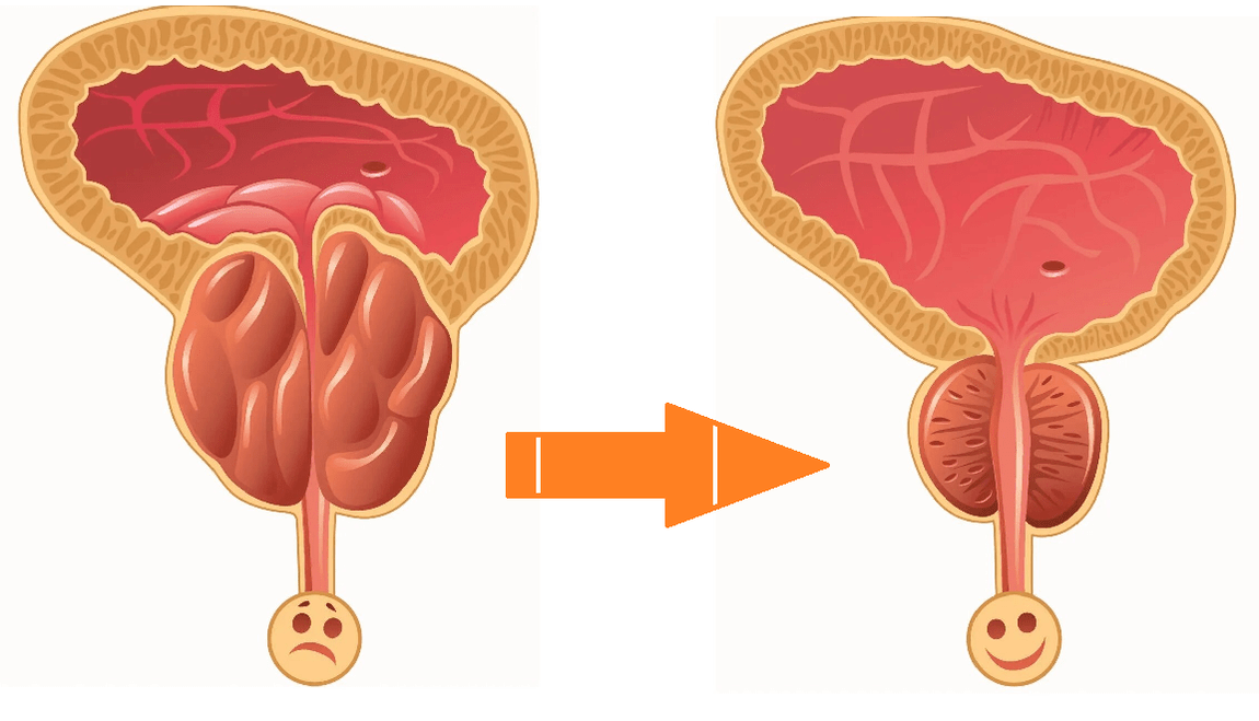 Uromexil Forte veiksmas dėl prostatos su prostatitu ir adenoma