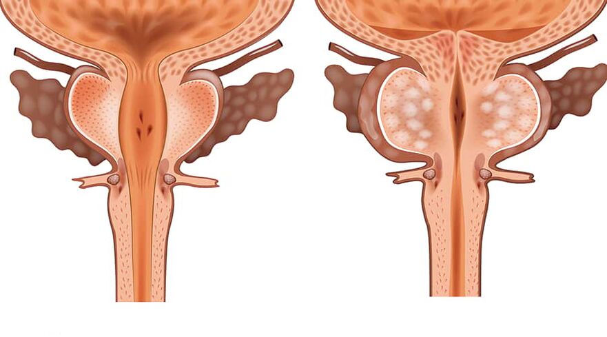 sveikos ir uždegusios adenomos palyginimas