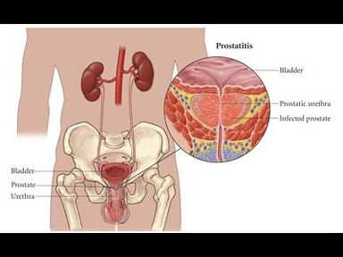 Prostatitas – prostatos liaukos uždegimas